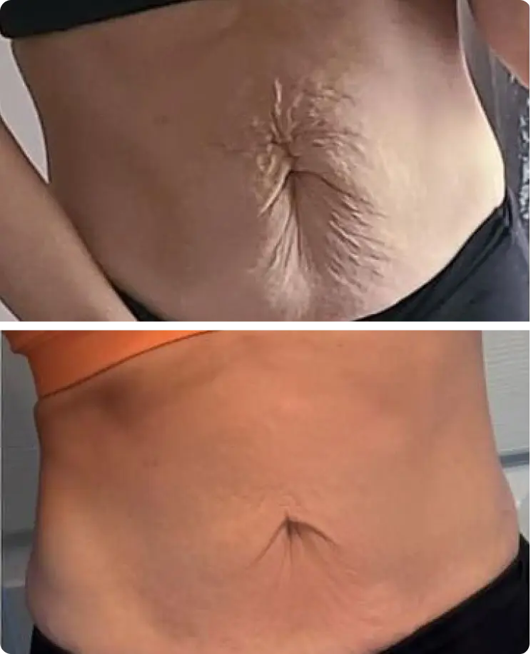 Glokore IPL Body Sculptor user Amanda L.